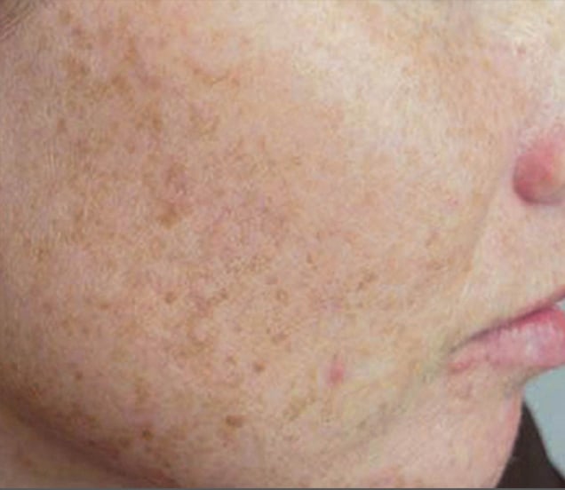 photofacial before close up of cheek with freckles before photofacial