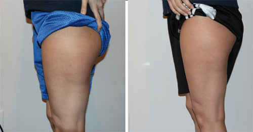before and after outer thigh and buttock showing less cellulite after cryolipolysis