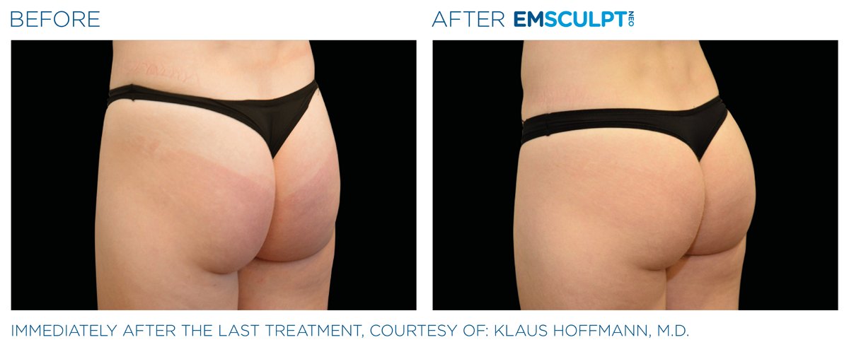Emsculpt NEO Northern VA before & after