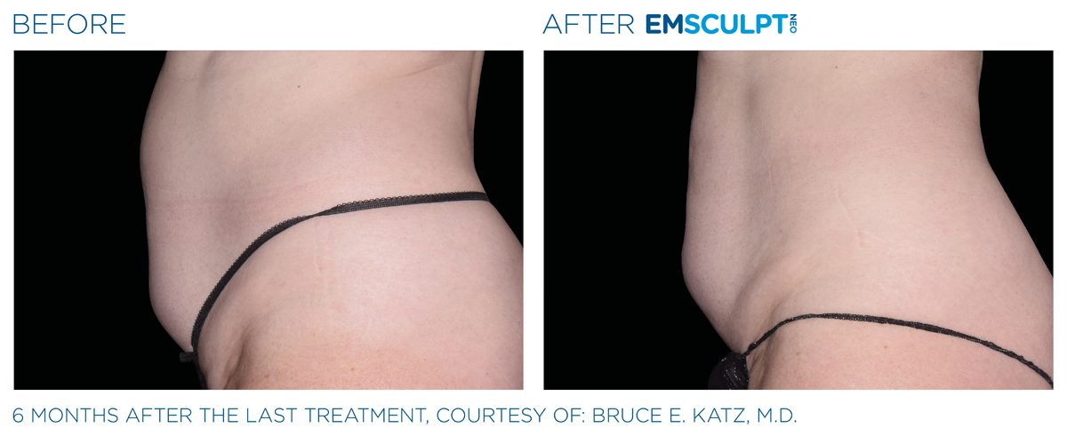 body contouring McLean VA abdomen