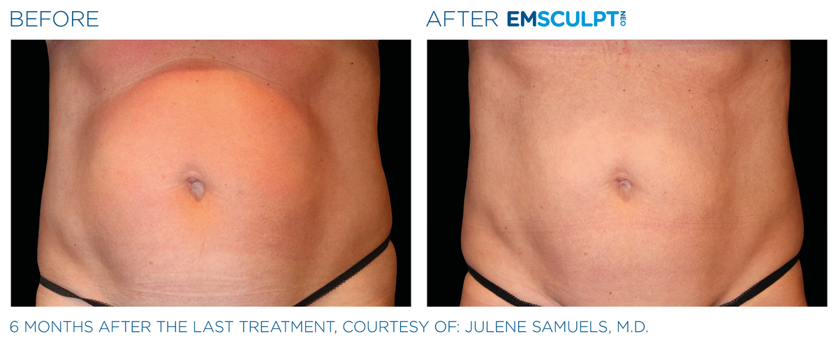 body contouring McLean VA abdomen