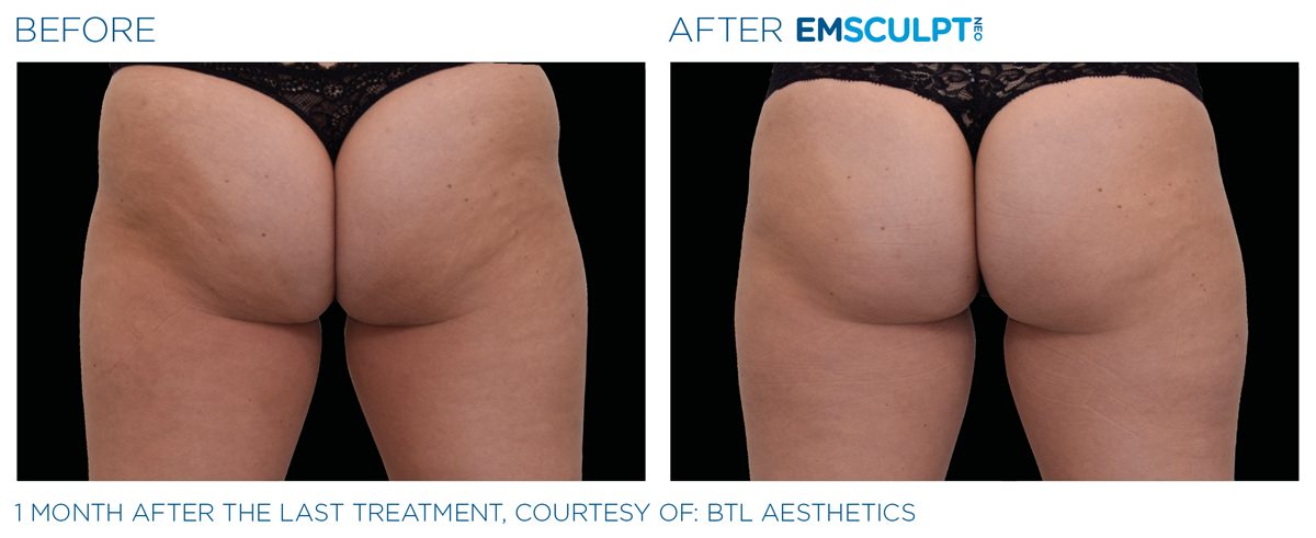 Emsculpt NEO Northern VA before & after