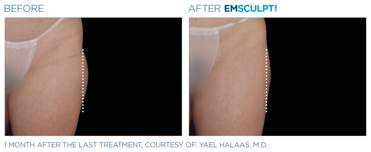 Emsculpt NEO Northern VA before & after