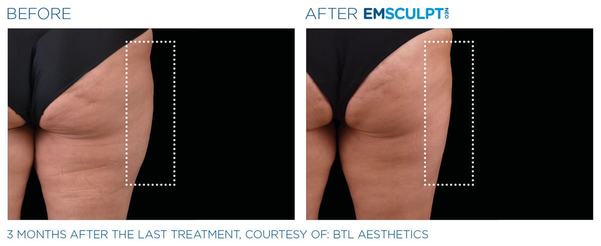Emsculpt_neo_PIC_Ba-card-female-outer_thighs-059_ENUS100