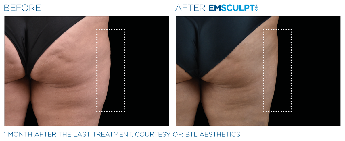 Emsculpt NEO Northern VA before & after saddlebags