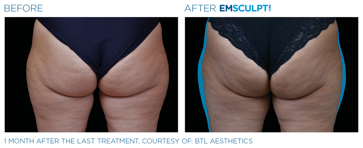 Emsculpt NEO Northern VA before & after saddlebags