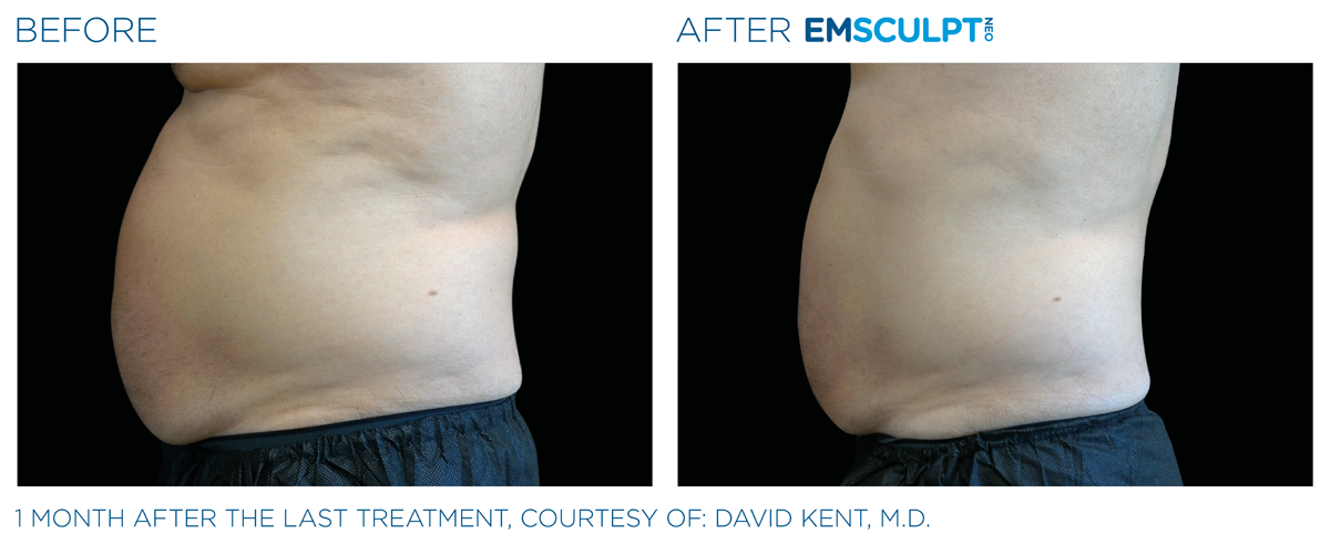 EmSculpt NEO near me before & after abdomen