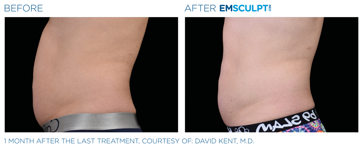 Emsculpt_neo_PIC_Ba-card-male-abdomen-014_ENUS100 EmSculpt NEO near me before & after abdomen