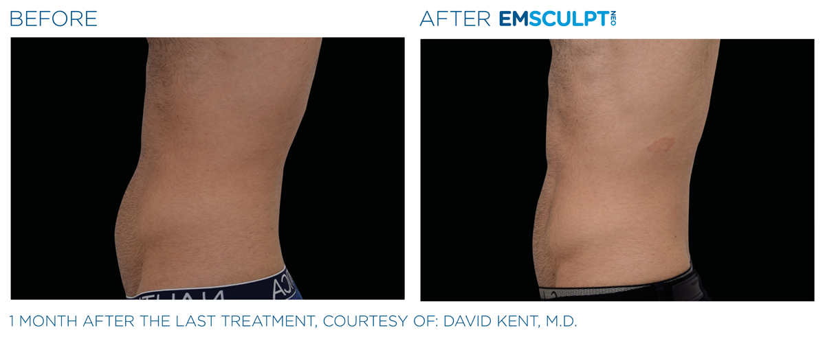 EmSculpt NEO near me before & after abdomen