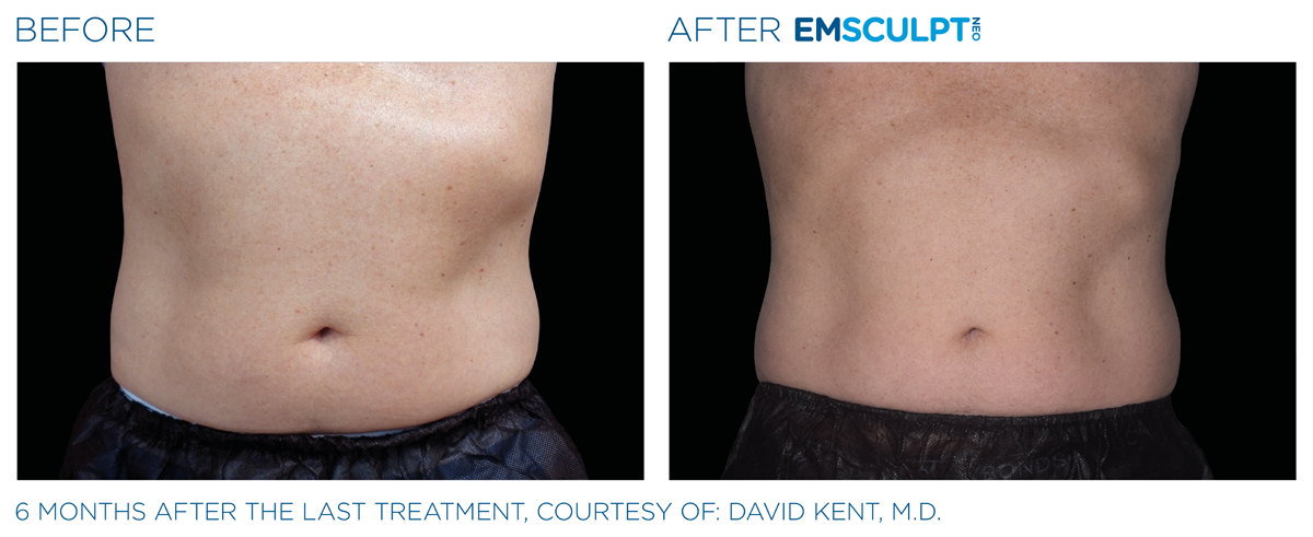 EmSculpt NEO near me before & after abdomen